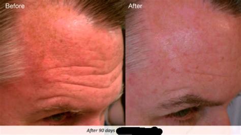 How To Correctly Use Retin A Tretinoin For Anti Aging Acne And Wrinkles