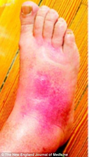 The Shocking Images That Reveal What Diabetes Can Do To Your Feet In