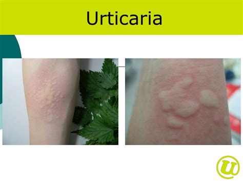 Ppt Urticaria Powerpoint Presentation Free Download Id9137568