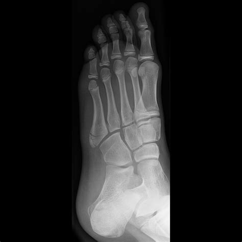 Physiosolutions Avulsion Fracture Of The 5th Toe After Ankle Sprain