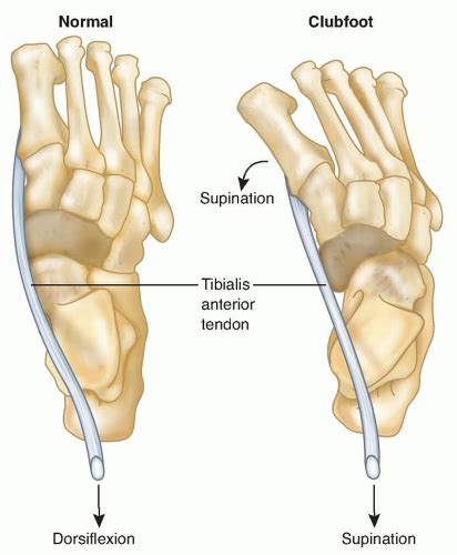 Anterior Tibialis Transfer For Residual Clubfoot Deformity Musculoskeletal Key