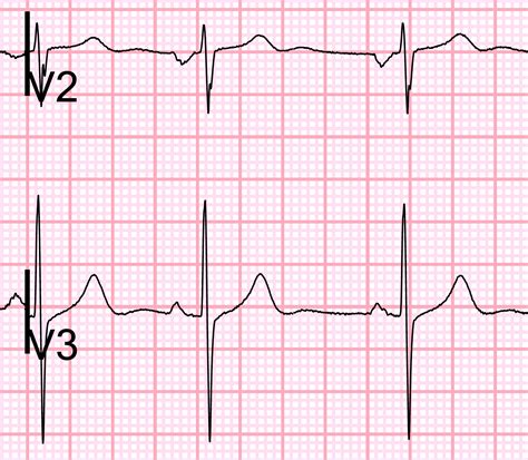 Dr Smiths Ecg Blog How Much St Depression In V2 And V3 Is Acceptable