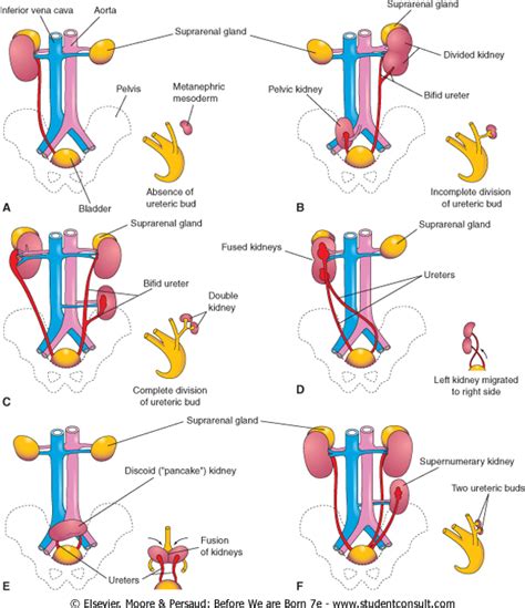 Congenital Abnormalities Development Of The Urinary System