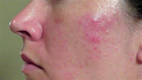 Cyst Acne Picture Acne Picture