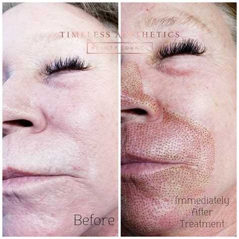 Fibroblast Skin Tightening Services In Parker Co Aesthetics 360