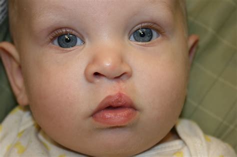 Cleft Lip And Palate Repair Causes Symptoms Treatment Cleft Lip And