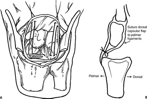 In cp's experience it can take several months to. Proximal Row Carpectomy with Capsular Resurfacing ...