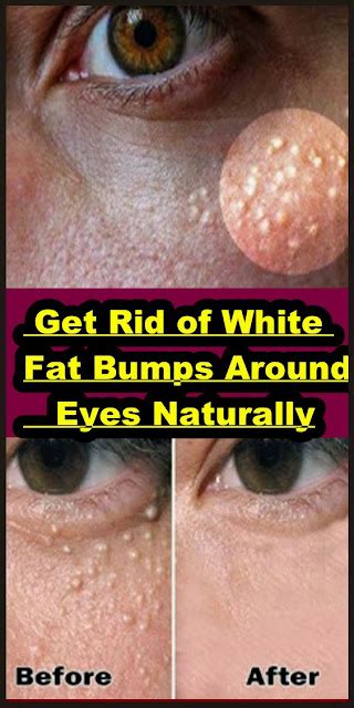 Get Rid Of White Fat Bumps Around Eyes Naturally Beauty4everything3