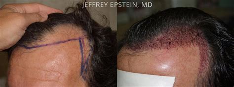 Hair Transplants For Men Photos Miami FL Patient39753