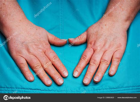 Hands Elderly Woman Pigmentation Protruding Veins Women Hands Women