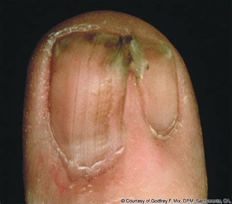 Pterygium Nails Causes Nail Ftempo