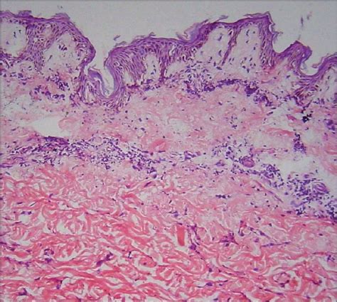 Morphea Histopathology