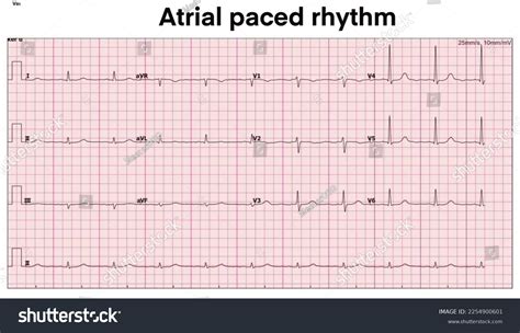 Electrocardiogram Show Atrial Paced Rhythm Cardiac Stock Illustration