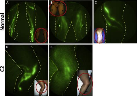 Degradation Of Lymphatic Anatomy And Function In Early Venous