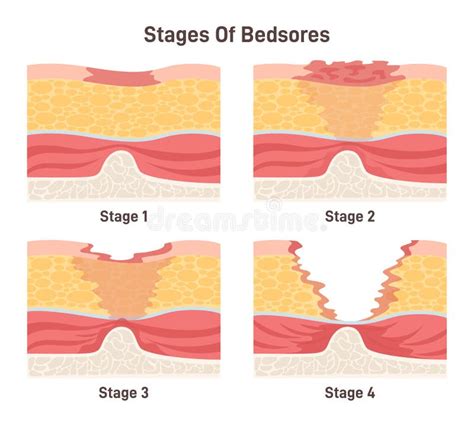 Bedsore Stages Set Pressure Sores Areas On Human Body Parts Stock
