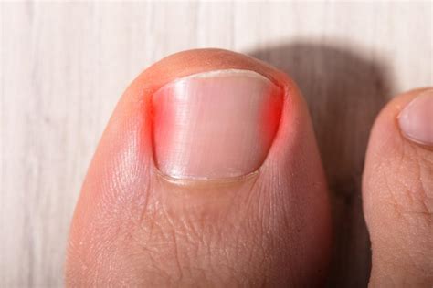 Here S Why You Should Never Ignore An Ingrown Toenail Gelbmann Podiatry