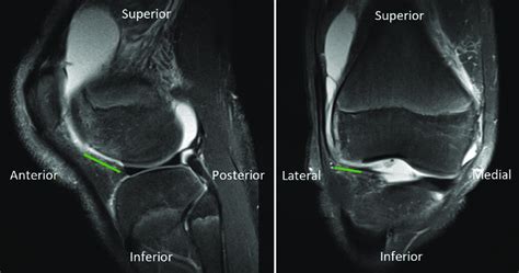 Preoperative Magnetic Resonance Imaging Mri Slices Of A Right Knee