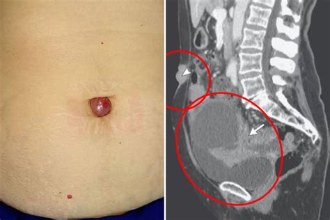 Woman With Strange Bulging Belly Button Discovers Its Rare Sign Of