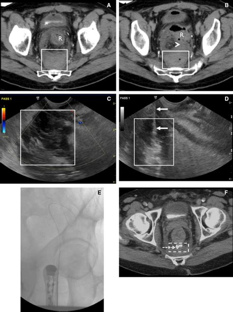 Transrectal Drainage Using Ultrasound And Fluoroscopic Guidance Download Scientific Diagram