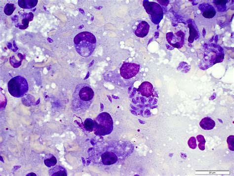 Pathology Outlines Toxoplasma Gondii