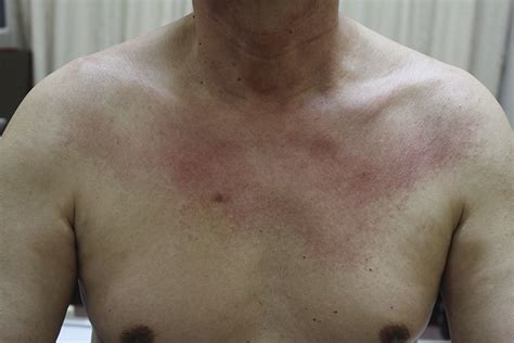 Figure1erythematous Rash Of The Patient The Distribution Of The