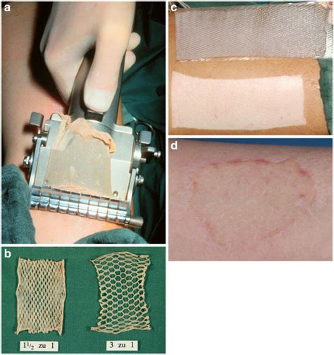 A Harvesting A Skin Graft With A Dermatome B Mesh Skin Graft With