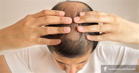 Scalp Exercises For Hair Loss Common Sense Hair Loss