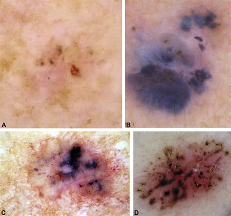 Basal Cell Carcinoma Journal Of The American Academy Of Dermatology