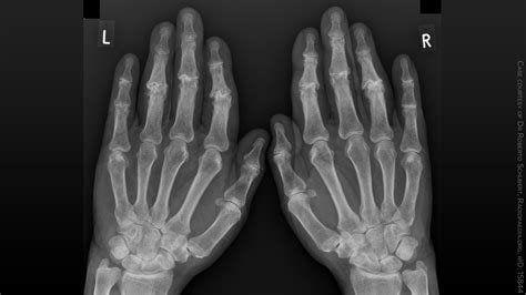 Effective Treatments For Hand Osteoarthritis The Search Goes On