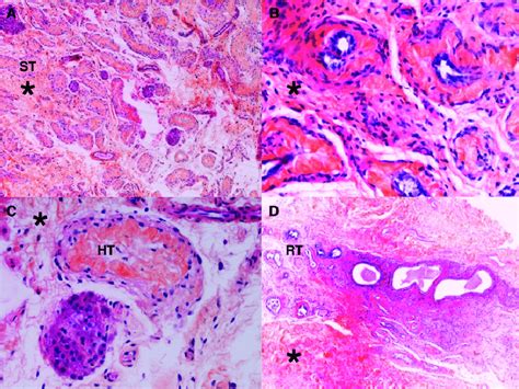 Gonadal Histology Of Subject 1 Photomicrographs Demonstrating Abnormal