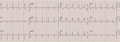 Dr Smiths Ecg Blog Right Bundle Branch Block Rbbb With
