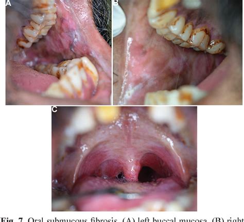 Figure 3 From Oral Health Consequences Of Smokeless Tobacco Use