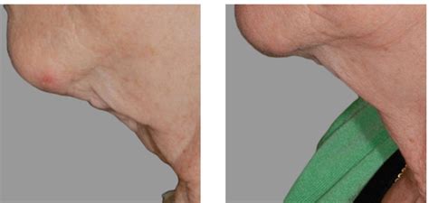 Thermage For Loose Skin Exilis For Body Shaping And Carboxytherapy For