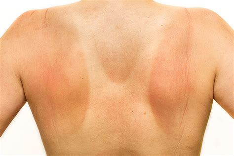 these awful tan lines will have you running for the shade