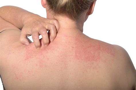 Itching And Scratching Contact Dermatitis During Pregnancy The Pulse
