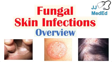 Overview Of Fungal Skin Infections Tinea Infections Youtube