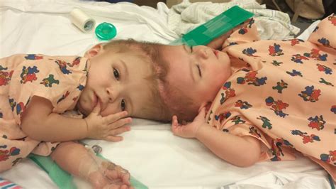 Conjoined Twins Separated Both Out Of Surgery Cnn