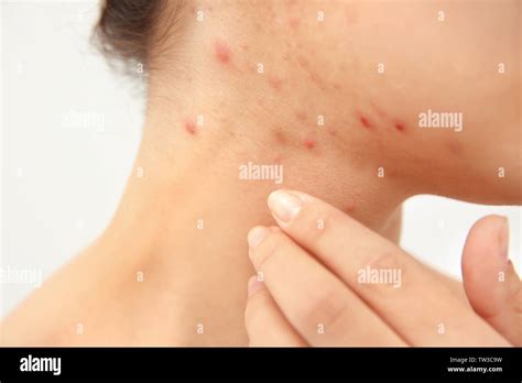 Allergy Concept Young Woman With Pimples On Her Face Closeup Stock
