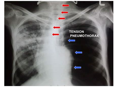 Pneumothorax is a collection of air in the pleural cavity between the visceral and parietal pleura resulting into loss of the normal negative sucking. Pin on medicine