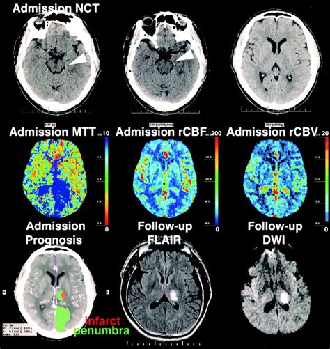 Accuracy Of Dynamic Perfusion Ct With Deconvolution In Detecting Acute