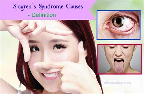 All About Sjogrens Syndrome Causes Symptoms And Cure