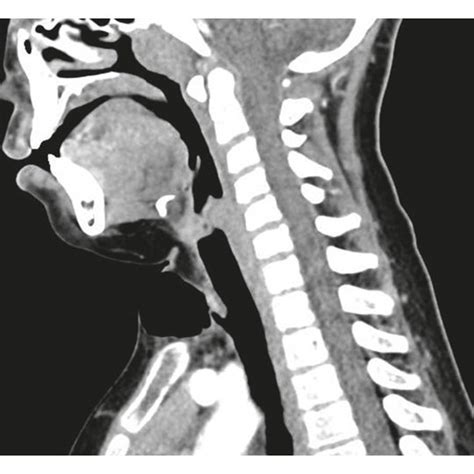 An 8 Year Old Child With 3 Cm Diameter Anterior Midline Neck Swelling