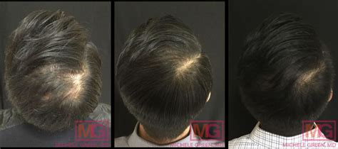 Does Ozempic Cause Hair Loss Bss News
