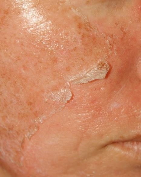Flaky Skin Symptoms Treatment Causes Pictures