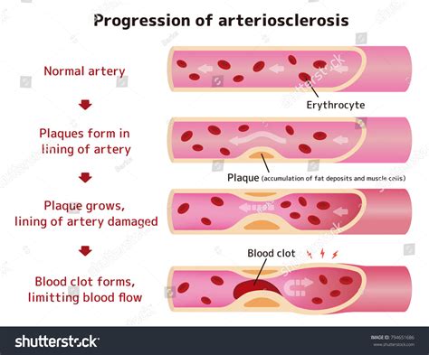 Progression Arteriosclerosis Illustration English Stock Vector Royalty