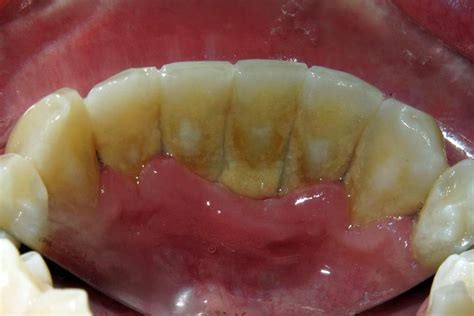 Gum Disease Raber Dental Kidron Dentist