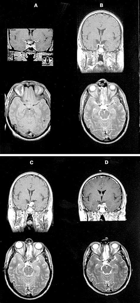 Relapsing Intracranial Rosai Dorfman Disease Journal Of Neurology