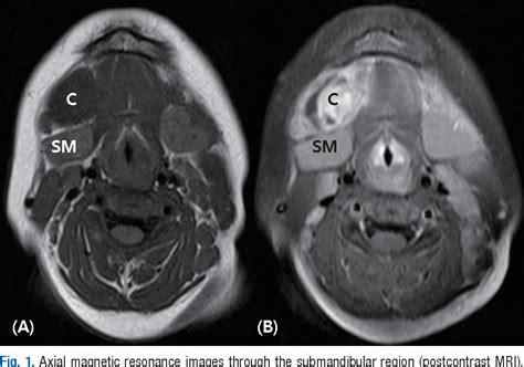 Figure 1 From A Case Of Bilateral Submandibular Gland Mucoceles In A 16