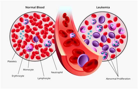 Acute Myeloid Leukemia Aml Free Transparent Clipart Clipartkey