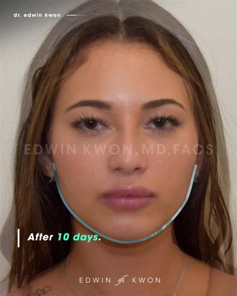 Buccal Fat Removal Surgery Before After GRAPHIC Video RealSelf